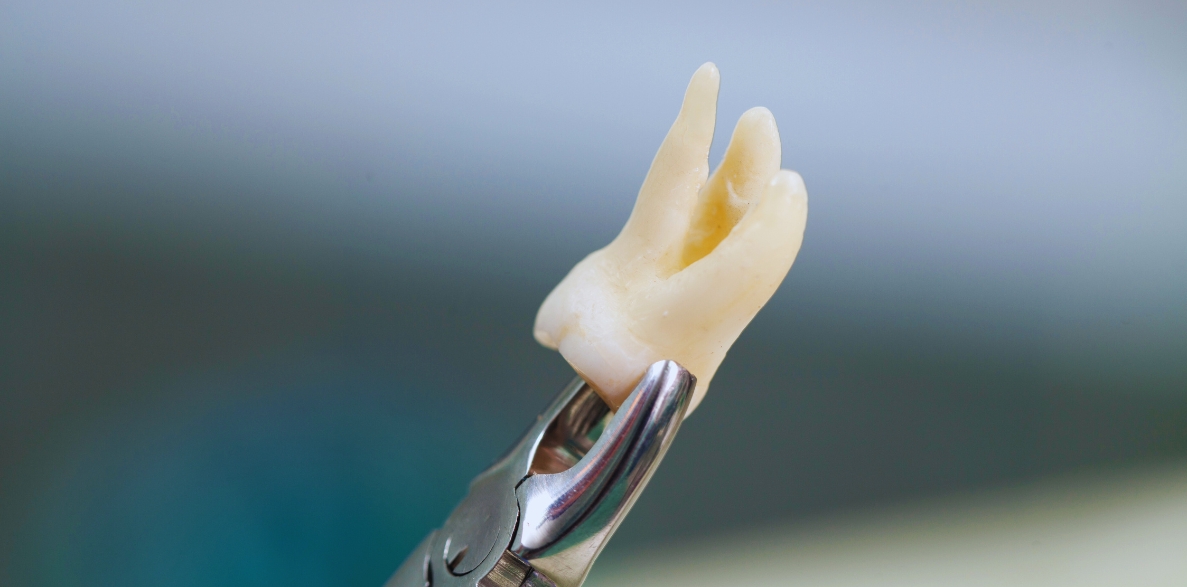 key factors to consider before tooth extractions