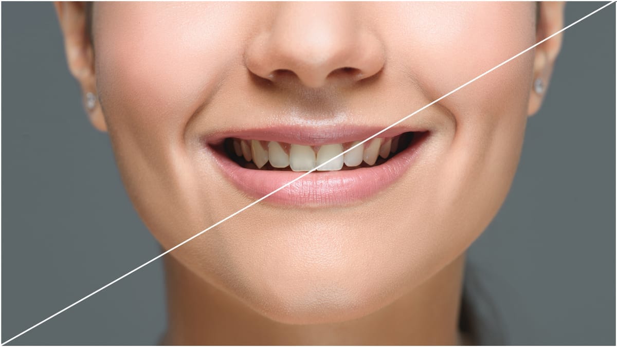 Teeth Whitening in West Boylston