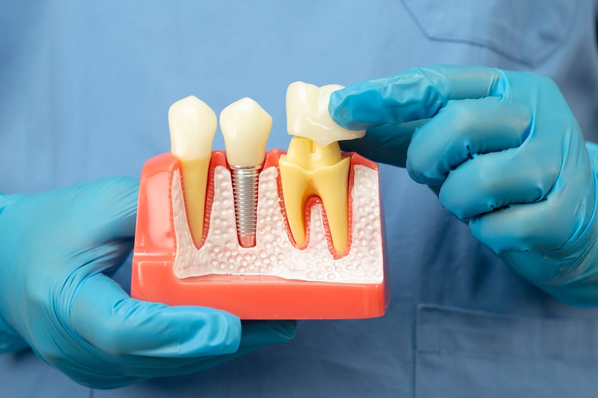 Dental Crowns in Holden