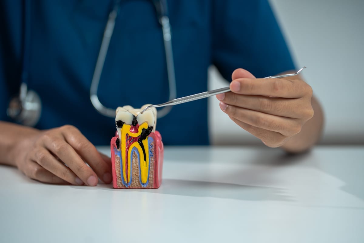 Root Canal Treatment in Holden